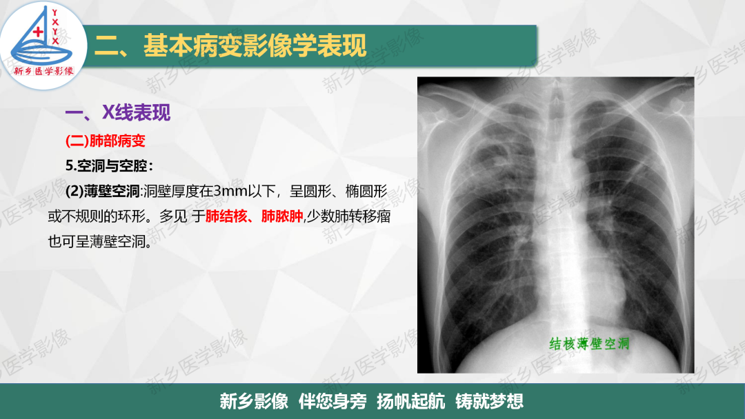 影像PPT - 【PPT】医学影像诊断学教材解读—胸部CT基本病变影像表现1-13