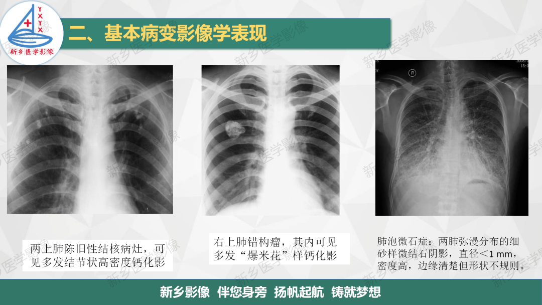 影像PPT - 【PPT】医学影像诊断学教材解读—胸部CT基本病变影像表现1-17