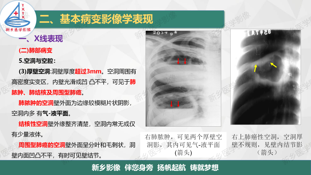 影像PPT - 【PPT】医学影像诊断学教材解读—胸部CT基本病变影像表现1-14