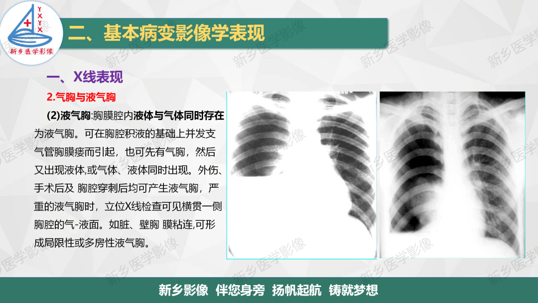 影像PPT - 【PPT】医学影像诊断学教材解读—胸部CT基本病变影像表现1-23