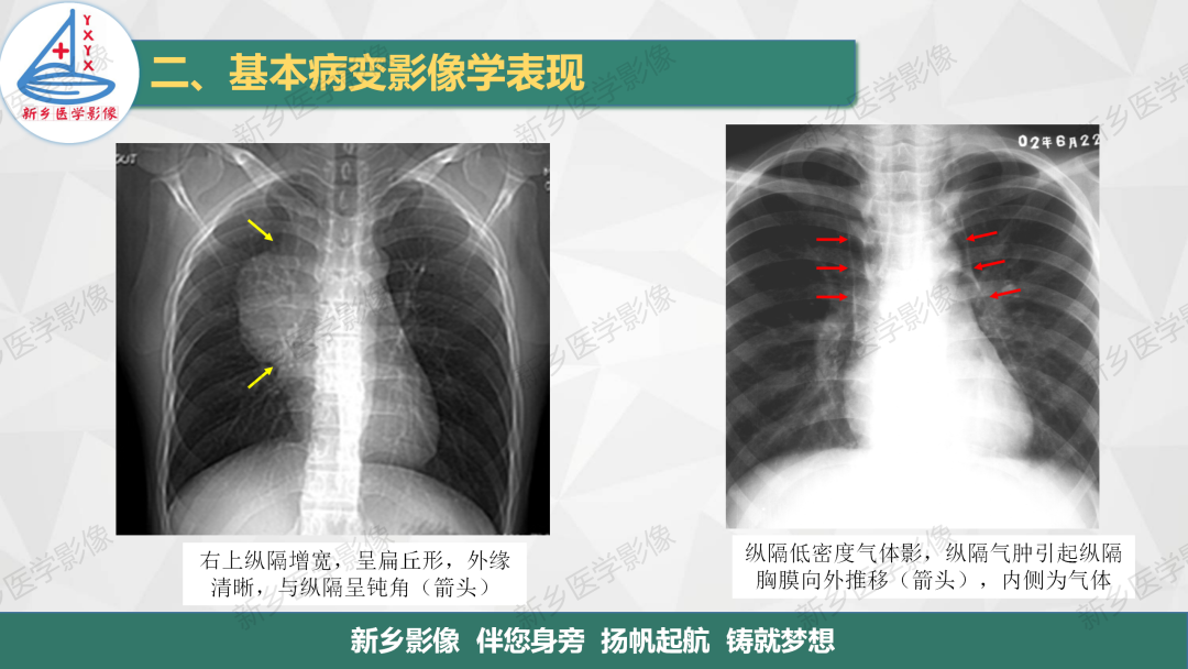 影像PPT - 【PPT】医学影像诊断学教材解读—胸部CT基本病变影像表现1-27
