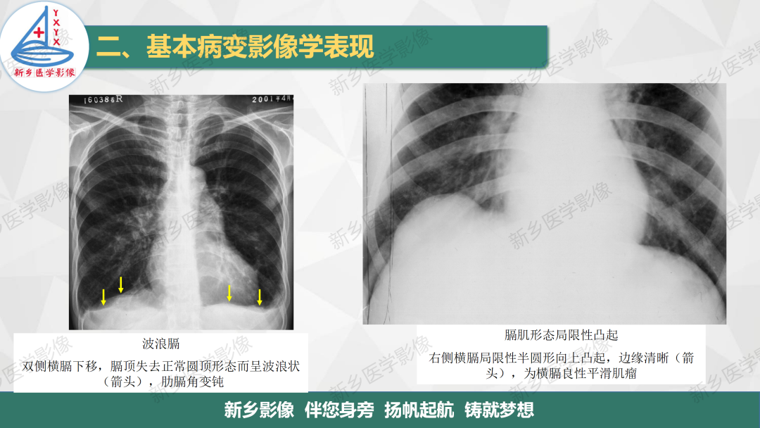 影像PPT - 【PPT】医学影像诊断学教材解读—胸部CT基本病变影像表现1-29