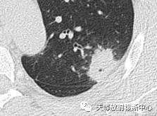 影像PPT - 【病例】机化性肺炎1例CT-2