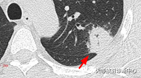 影像PPT - 【病例】机化性肺炎1例CT-4