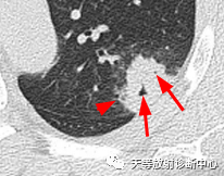 影像PPT - 【病例】机化性肺炎1例CT-3