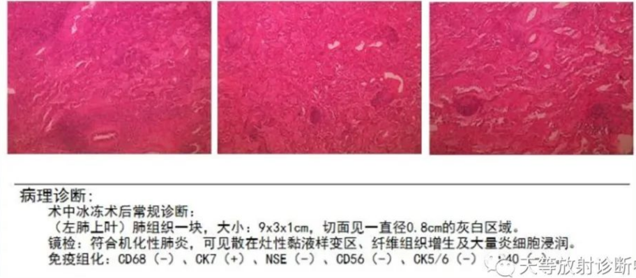 影像PPT - 【病例】机化性肺炎1例CT-9