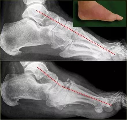 影像PPT - 糖尿病足MRI-4 影像PPT - 糖尿病足MRI-4