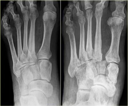 影像PPT - 糖尿病足MRI-6 影像PPT - 糖尿病足MRI-6