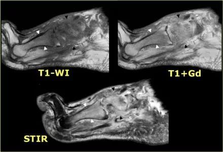 影像PPT - 糖尿病足MRI-5 影像PPT - 糖尿病足MRI-5