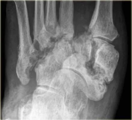影像PPT - 糖尿病足MRI-7 影像PPT - 糖尿病足MRI-7