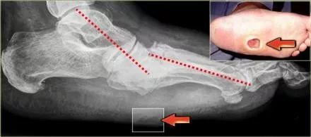 影像PPT - 糖尿病足MRI-8 影像PPT - 糖尿病足MRI-8