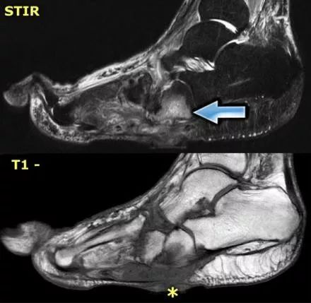 影像PPT - 糖尿病足MRI-9 影像PPT - 糖尿病足MRI-9