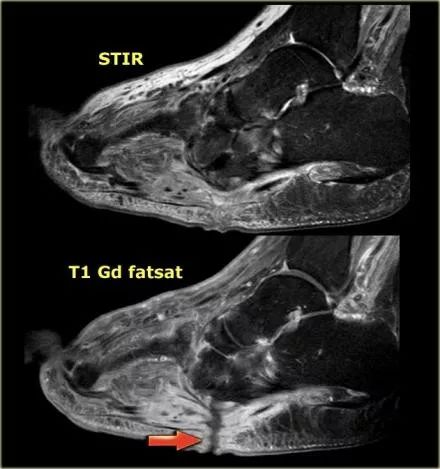 影像PPT - 糖尿病足MRI-11 影像PPT - 糖尿病足MRI-11