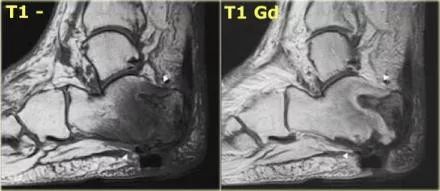 影像PPT - 糖尿病足MRI-12 影像PPT - 糖尿病足MRI-12