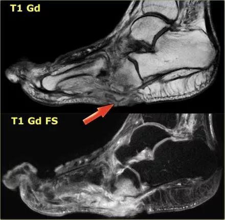 影像PPT - 糖尿病足MRI-10 影像PPT - 糖尿病足MRI-10