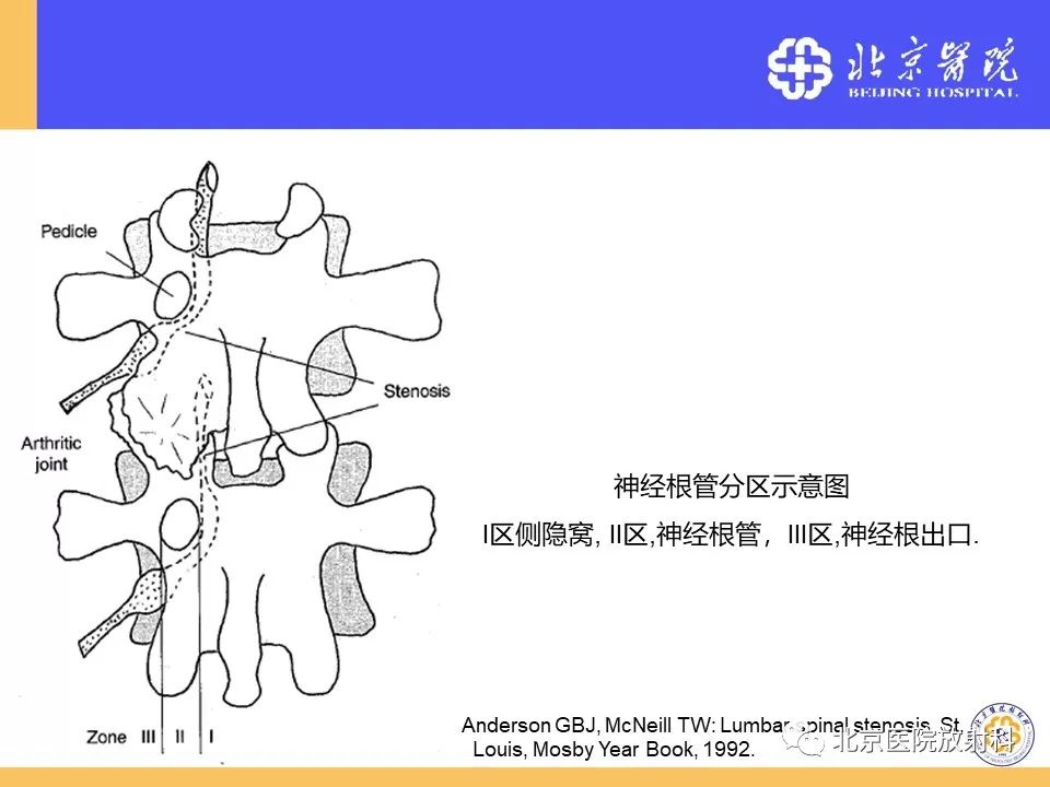 影像PPT - 【PPT】椎管狭窄的影像学检查-9
