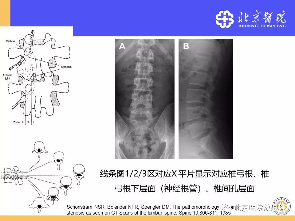 影像PPT - 【PPT】椎管狭窄的影像学检查-10