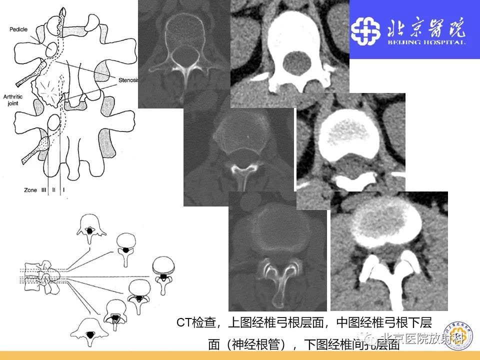 影像PPT - 【PPT】椎管狭窄的影像学检查-11