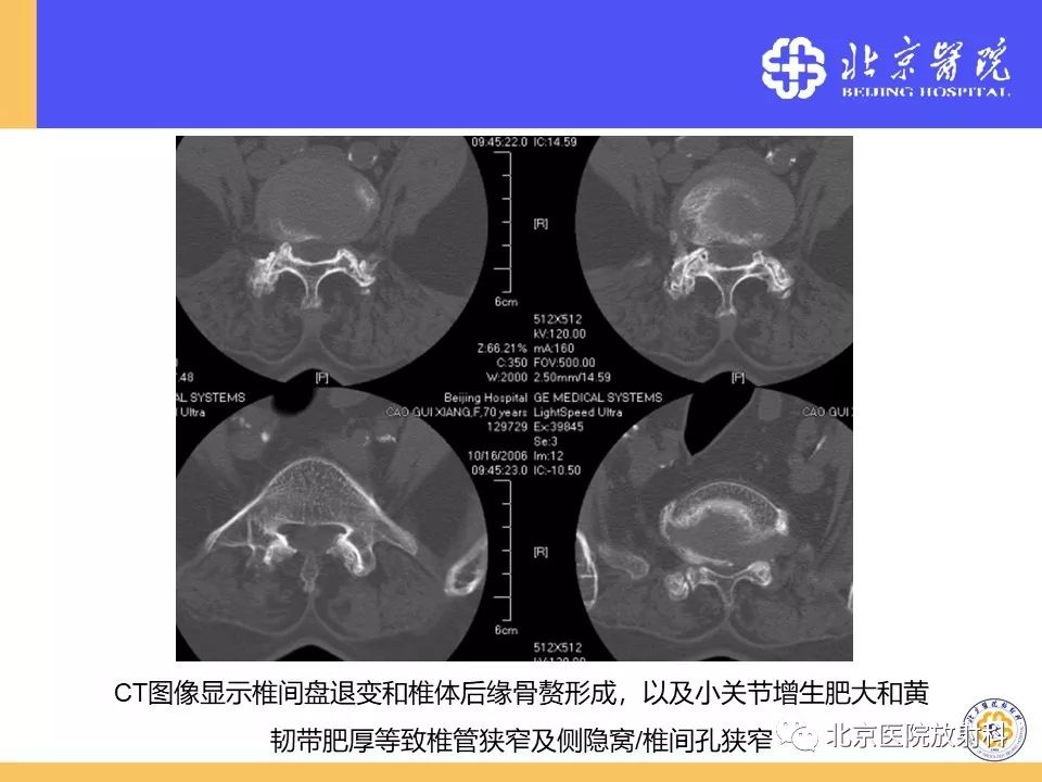 影像PPT - 【PPT】椎管狭窄的影像学检查-14