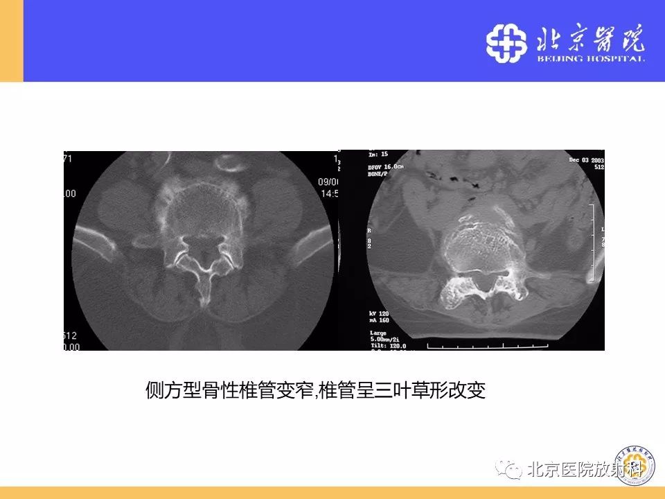 影像PPT - 【PPT】椎管狭窄的影像学检查-21