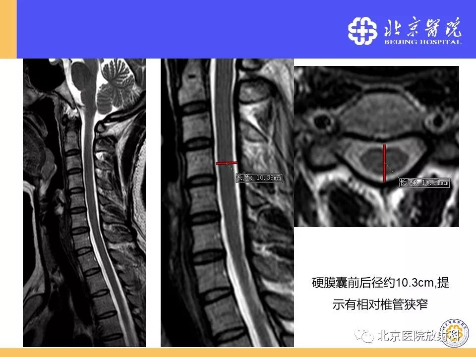 影像PPT - 【PPT】椎管狭窄的影像学检查-26