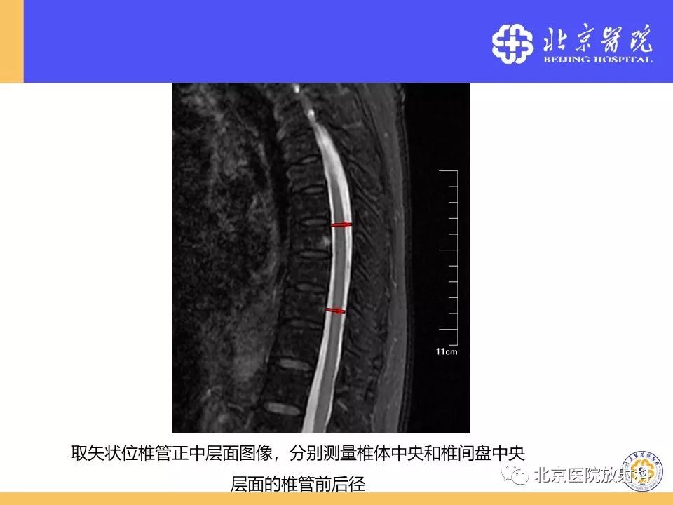 影像PPT - 【PPT】椎管狭窄的影像学检查-24