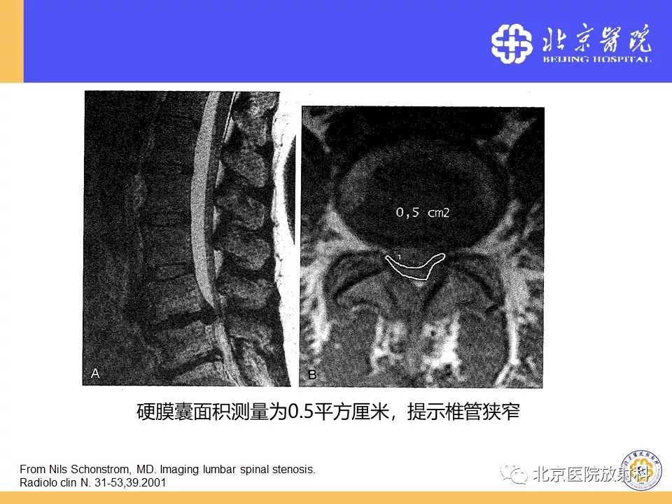 影像PPT - 【PPT】椎管狭窄的影像学检查-27