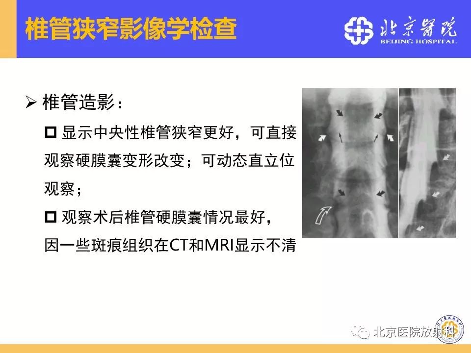 影像PPT - 【PPT】椎管狭窄的影像学检查-32