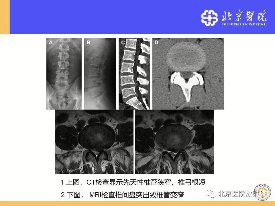 影像PPT - 【PPT】椎管狭窄的影像学检查-35