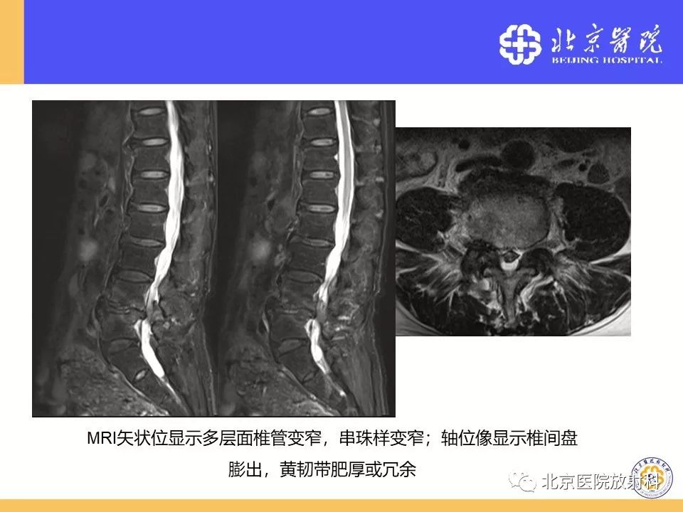 影像PPT - 【PPT】椎管狭窄的影像学检查-36