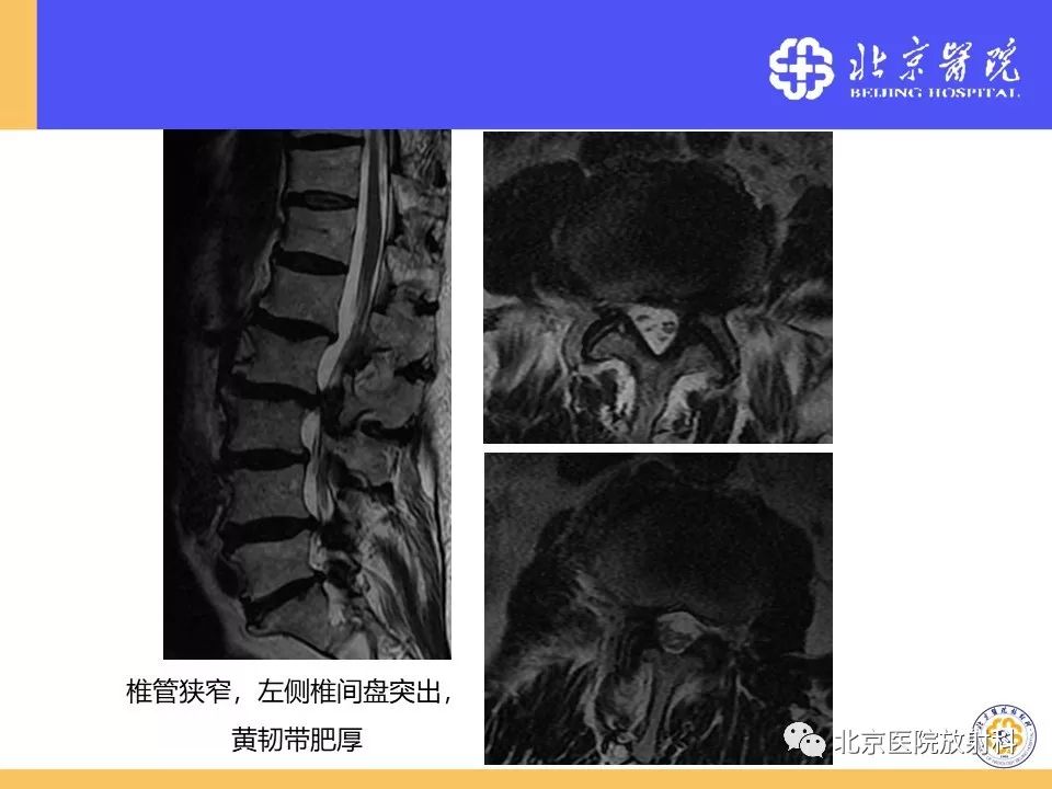 影像PPT - 【PPT】椎管狭窄的影像学检查-37