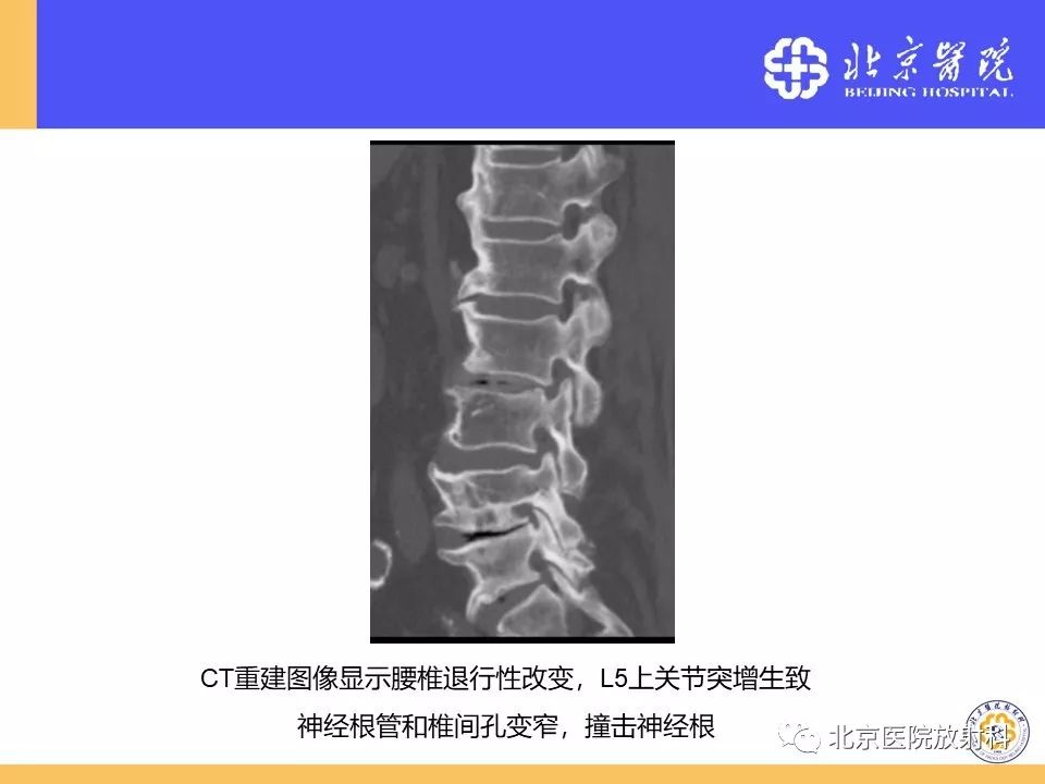 影像PPT - 【PPT】椎管狭窄的影像学检查-38