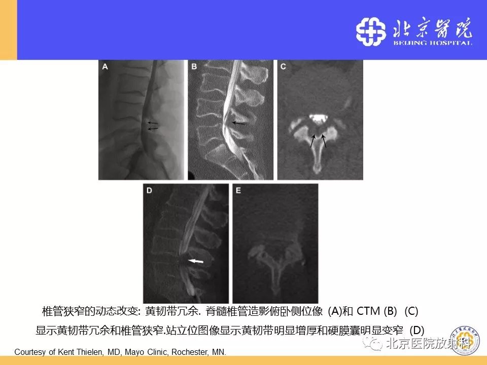影像PPT - 【PPT】椎管狭窄的影像学检查-39