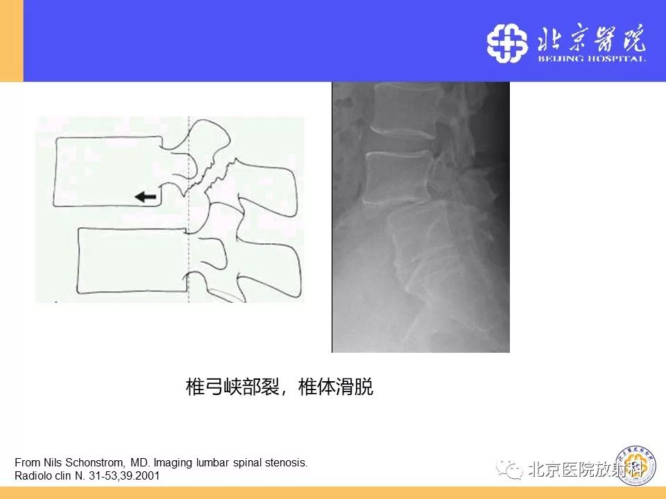 影像PPT - 【PPT】椎管狭窄的影像学检查-47
