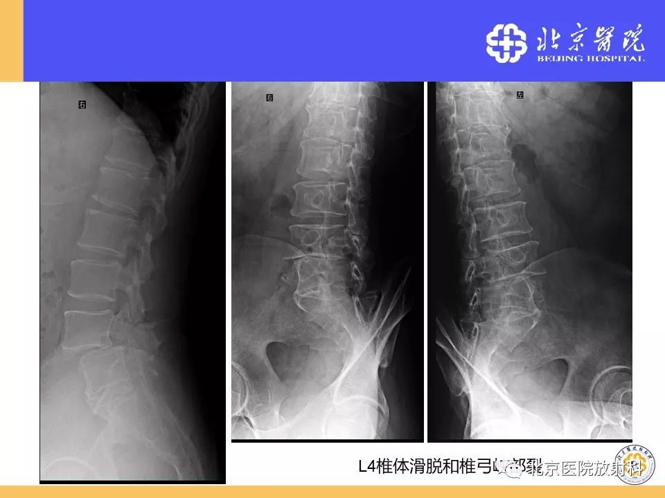 影像PPT - 【PPT】椎管狭窄的影像学检查-48