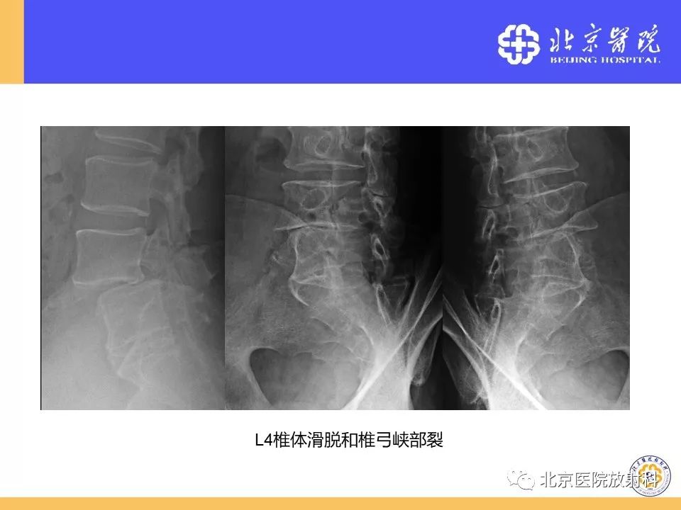 影像PPT - 【PPT】椎管狭窄的影像学检查-49