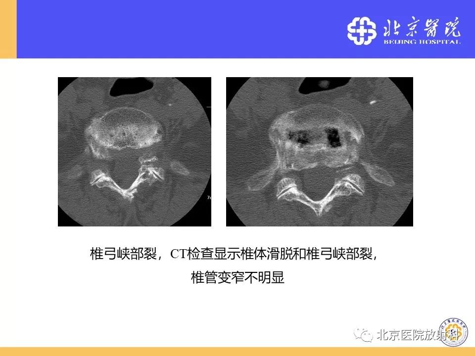 影像PPT - 【PPT】椎管狭窄的影像学检查-50