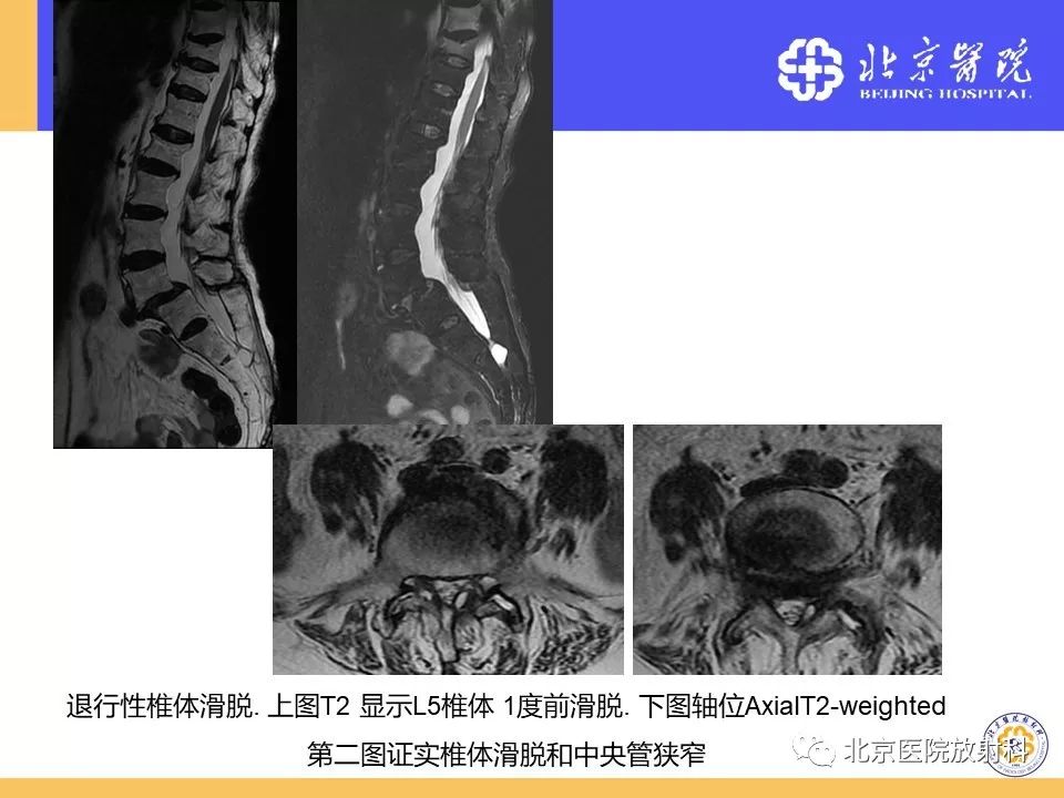 影像PPT - 【PPT】椎管狭窄的影像学检查-51