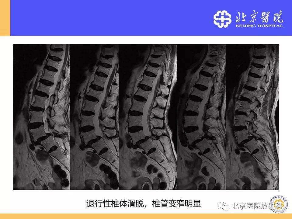 影像PPT - 【PPT】椎管狭窄的影像学检查-52