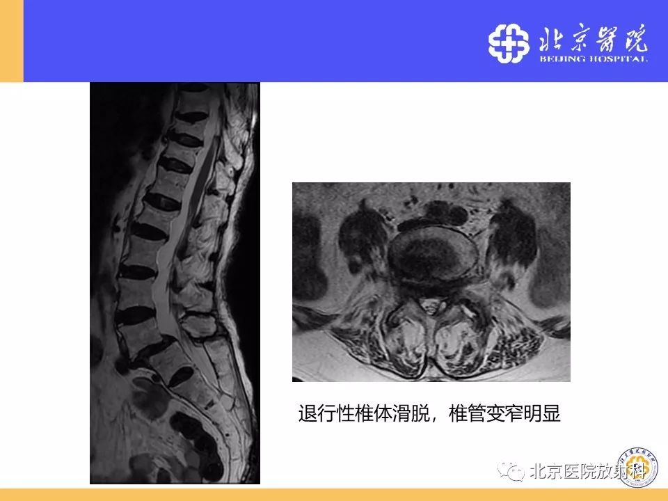 影像PPT - 【PPT】椎管狭窄的影像学检查-53