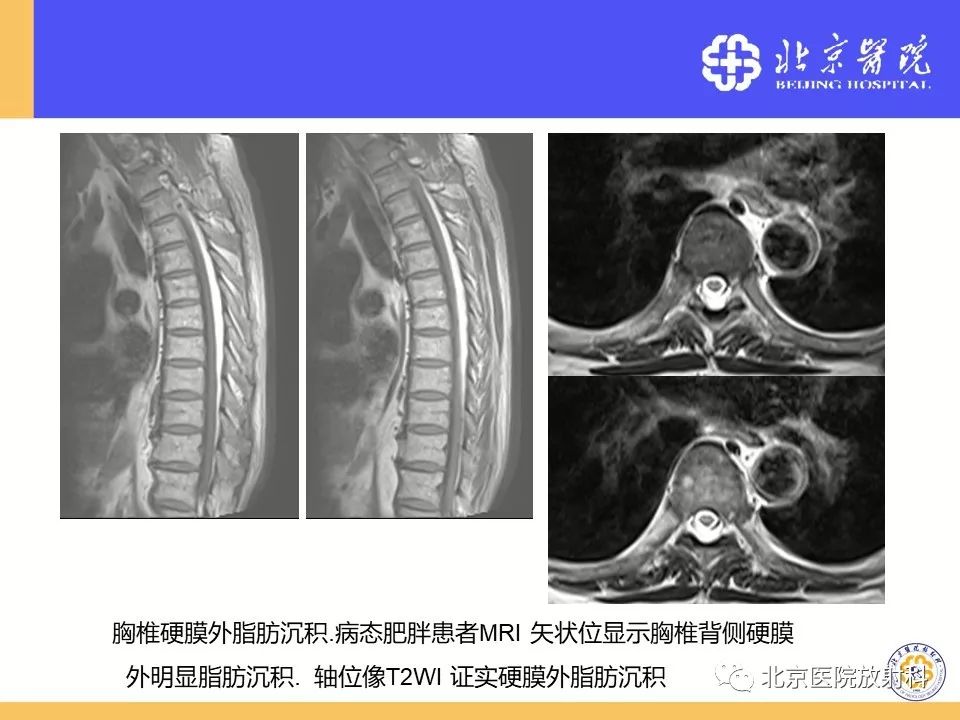影像PPT - 【PPT】椎管狭窄的影像学检查-56