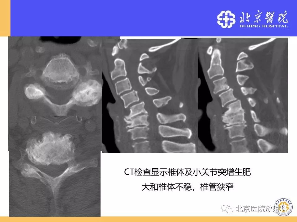 影像PPT - 【PPT】椎管狭窄的影像学检查-64