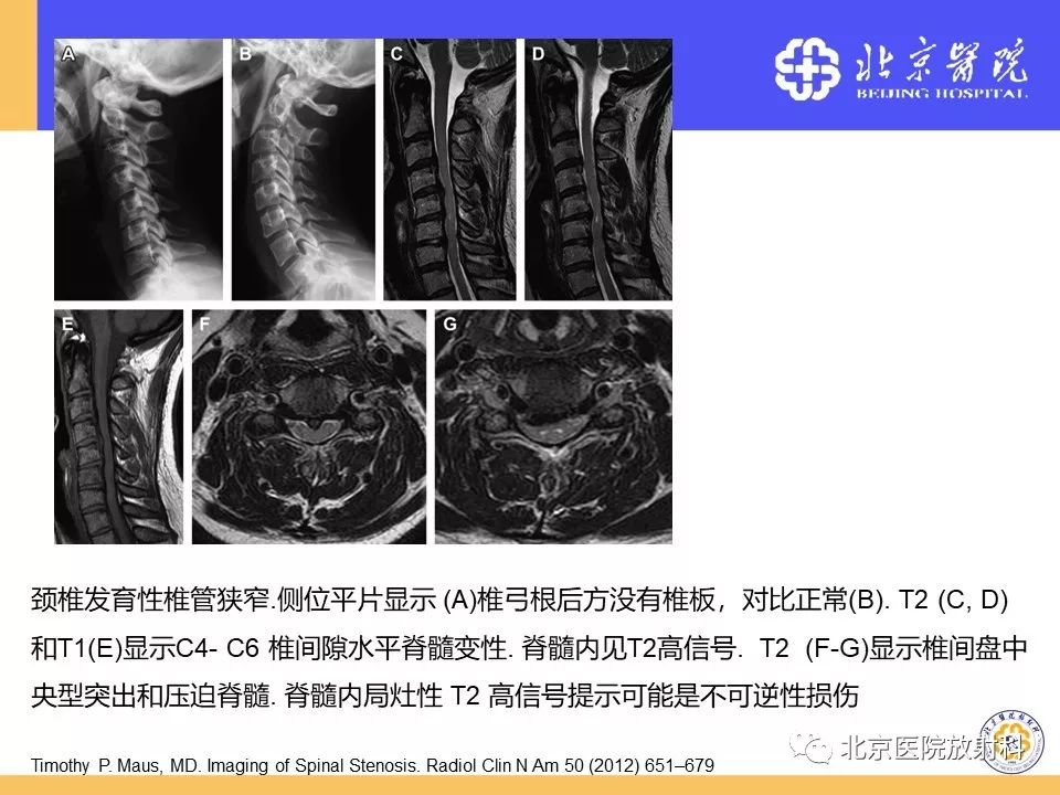 影像PPT - 【PPT】椎管狭窄的影像学检查-65