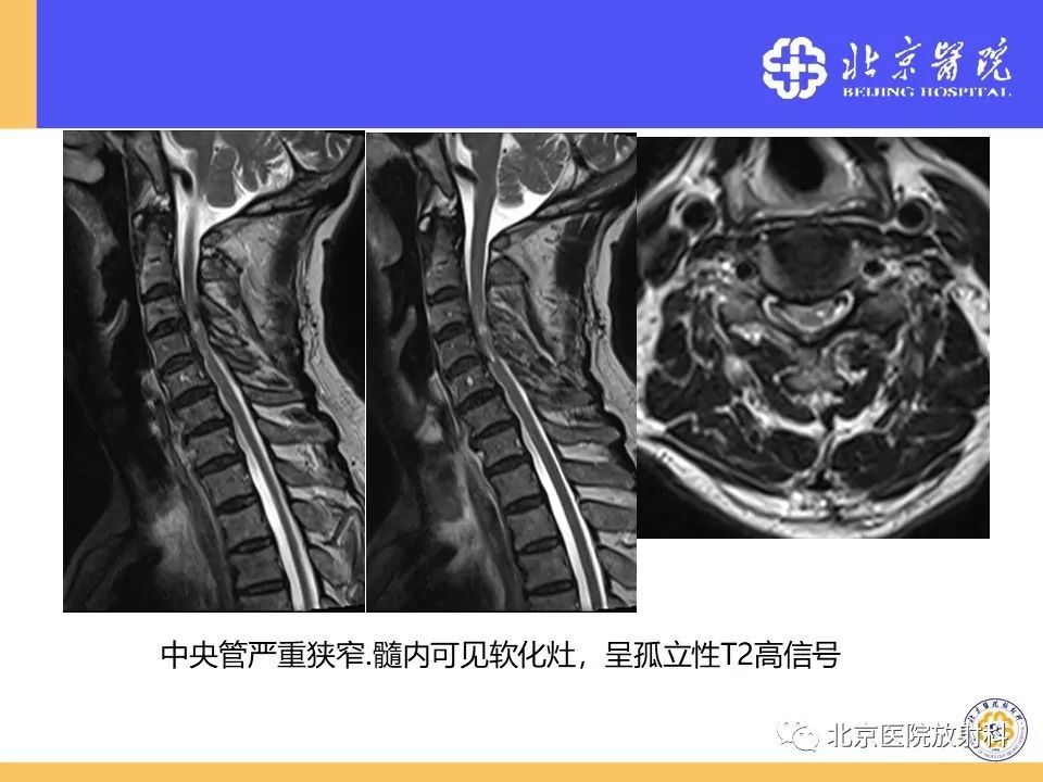 影像PPT - 【PPT】椎管狭窄的影像学检查-66
