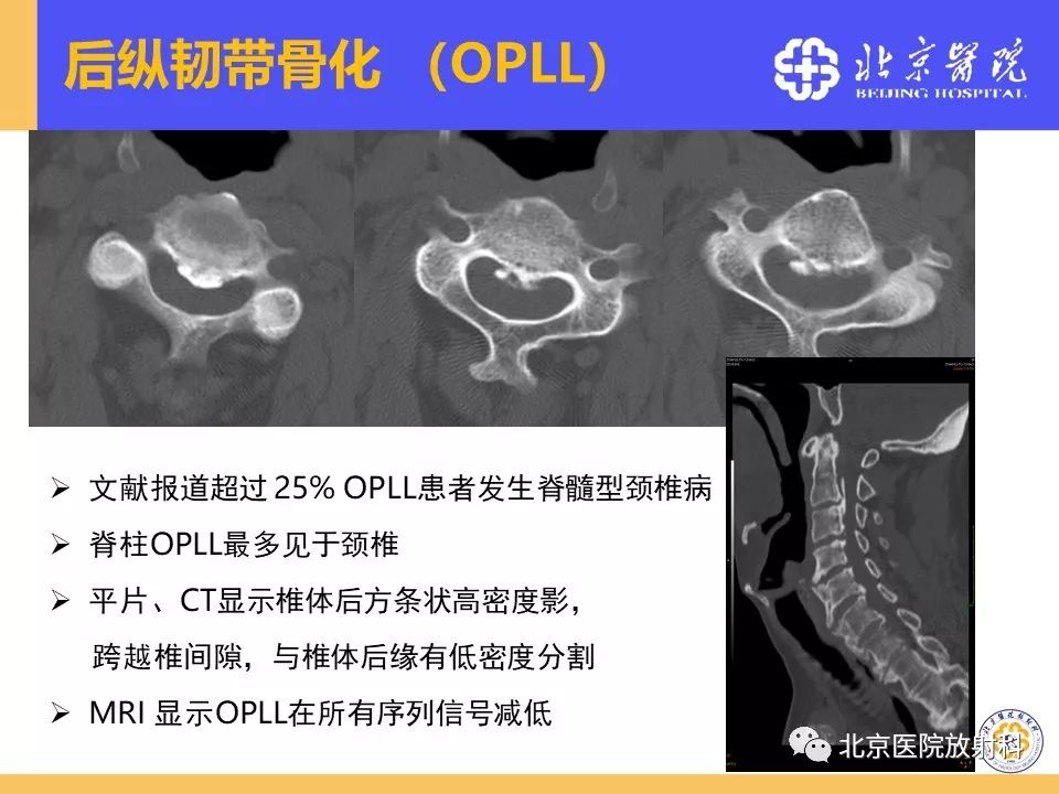 影像PPT - 【PPT】椎管狭窄的影像学检查-67