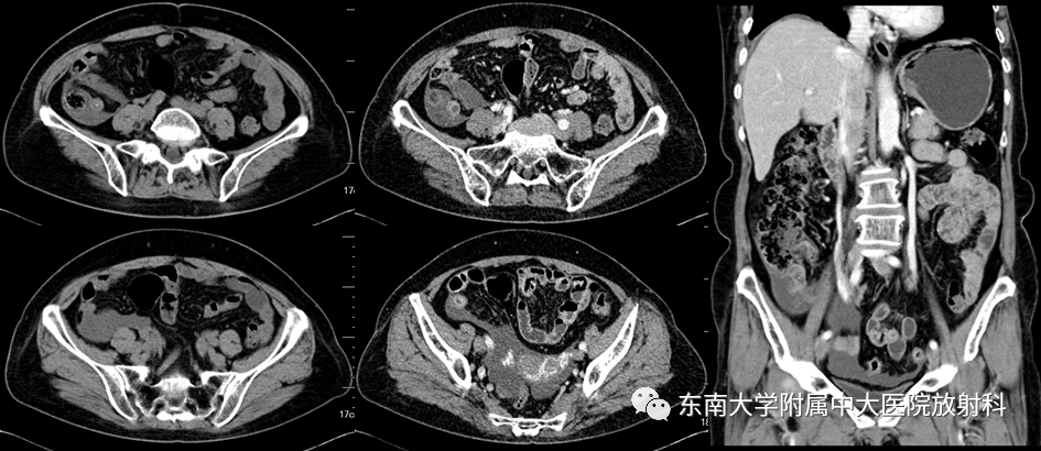 影像PPT - 【PPT】阑尾黏液性肿瘤-1