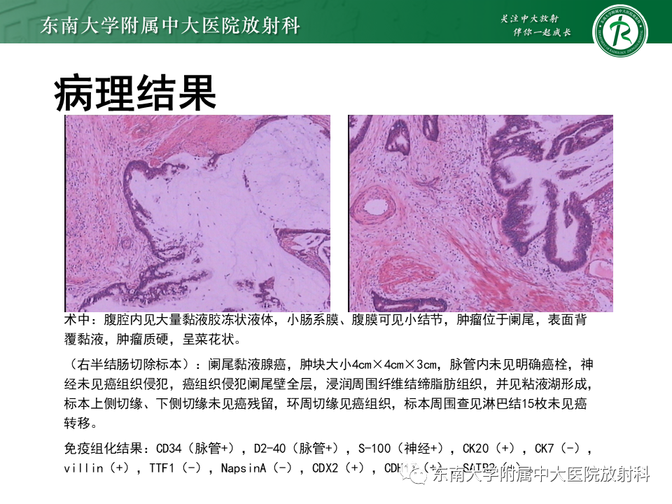 影像PPT - 【PPT】阑尾黏液性肿瘤-2