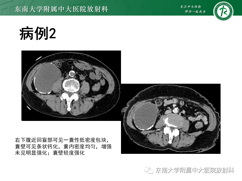 影像PPT - 【PPT】阑尾黏液性肿瘤-11