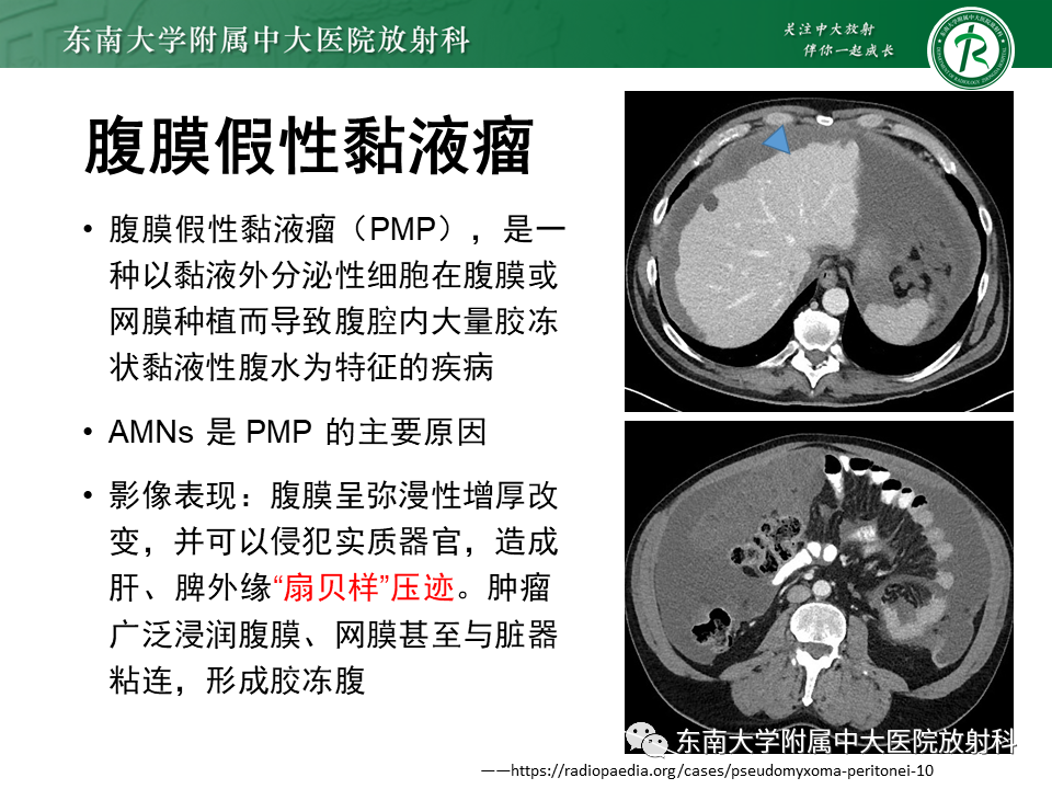 影像PPT - 【PPT】阑尾黏液性肿瘤-10