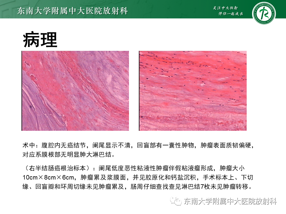 影像PPT - 【PPT】阑尾黏液性肿瘤-12